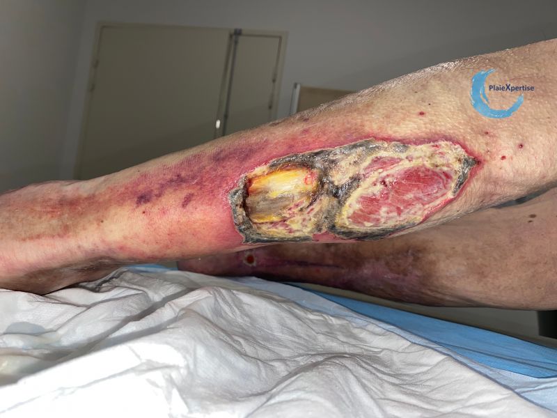 Fichier:Angiodermite typique127.jpg