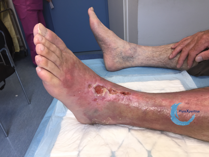 Fichier:Cou de pied50.png
