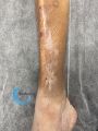 Dermatoporose37.jpg
