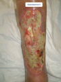 Tendon-Voussure10.png