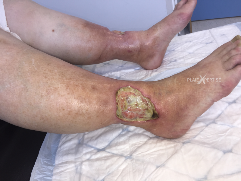 Fichier:Tendon-Voussure14.png