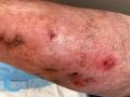 Pustules21.jpg