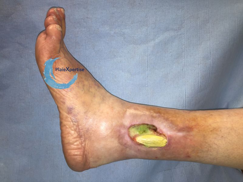 Fichier:Tendon nécrotique humide53.jpg