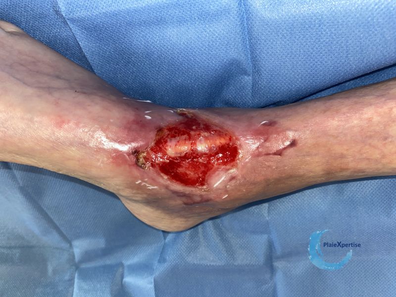 Fichier:Cou de pied79.jpg