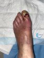 Pied infecté5.jpg
