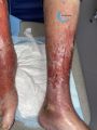 Dermite d'irritation120.jpg