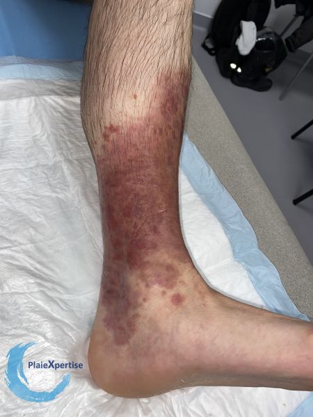 Fichier:Eczéma116.jpg