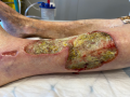 Pyoderma gangrenosum24.png