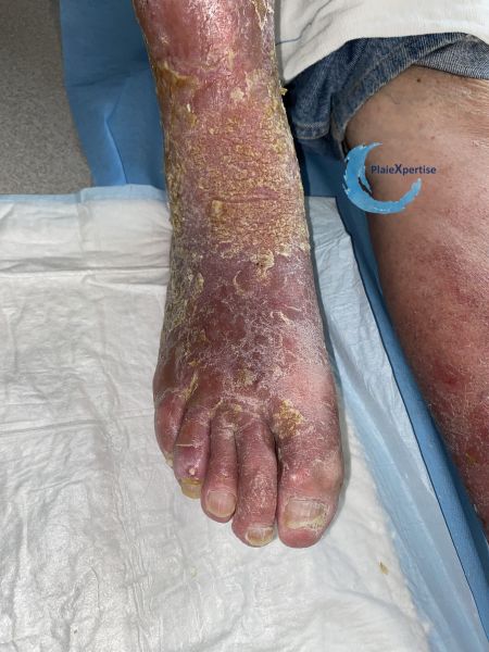 Fichier:Eczéma87.jpg