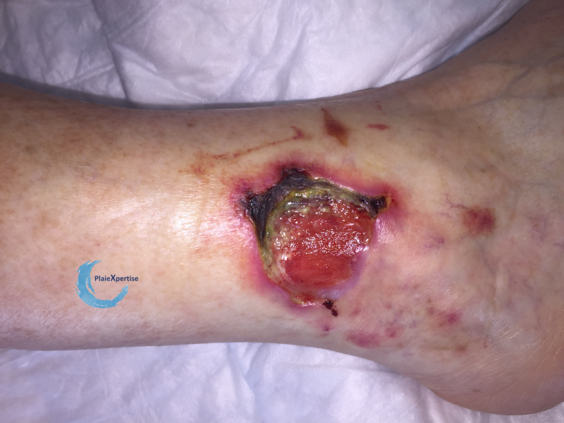 Fichier:Angiodermite typique62.png