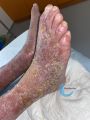 Eczéma86.jpg