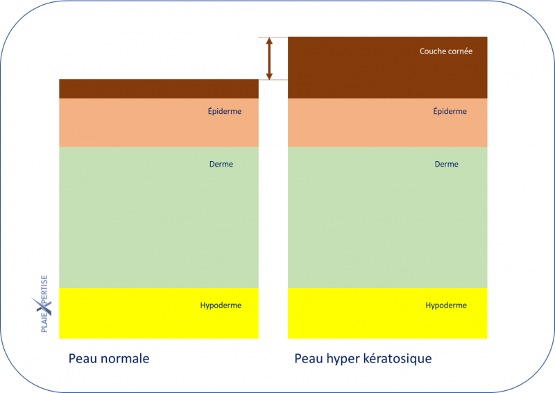 Fichier:Hyperkératose28.png
