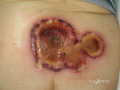 Lymphome cutané ulcéré6.png