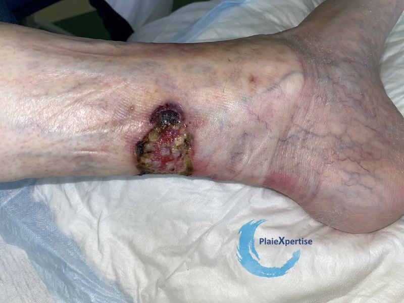 Fichier:Angiodermite typique86.jpg