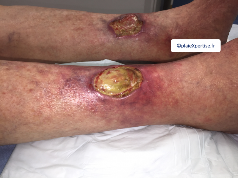 Fichier:Tendon-Voussure2.png