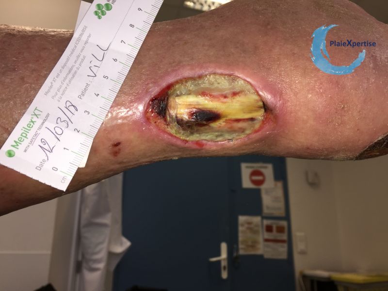 Fichier:Tendon nécrotique humide63.jpg