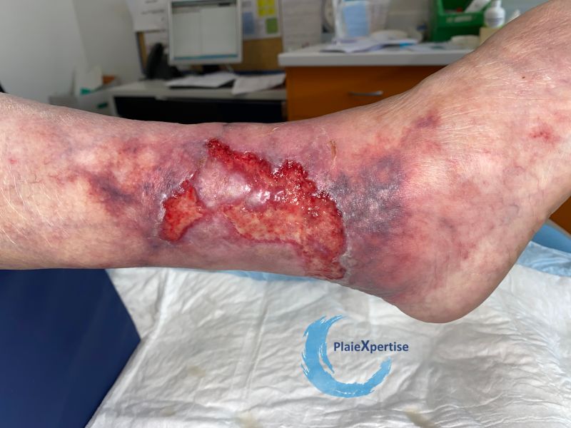 Fichier:Angiodermite typique81.jpg