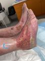 Dermite d'irritation170.jpg