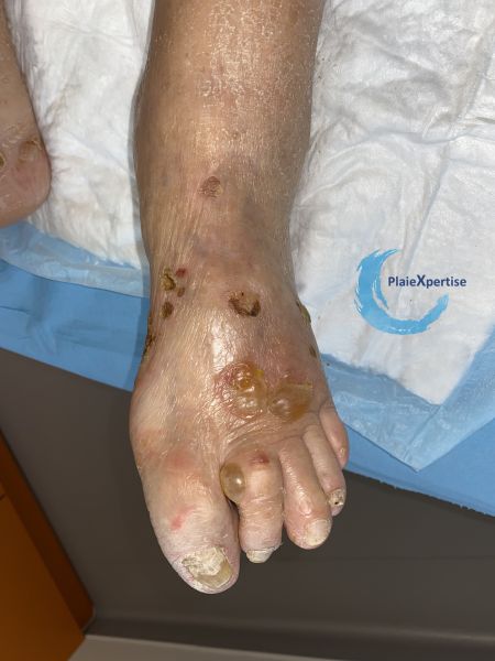 Fichier:Pemphigoïde35.jpg
