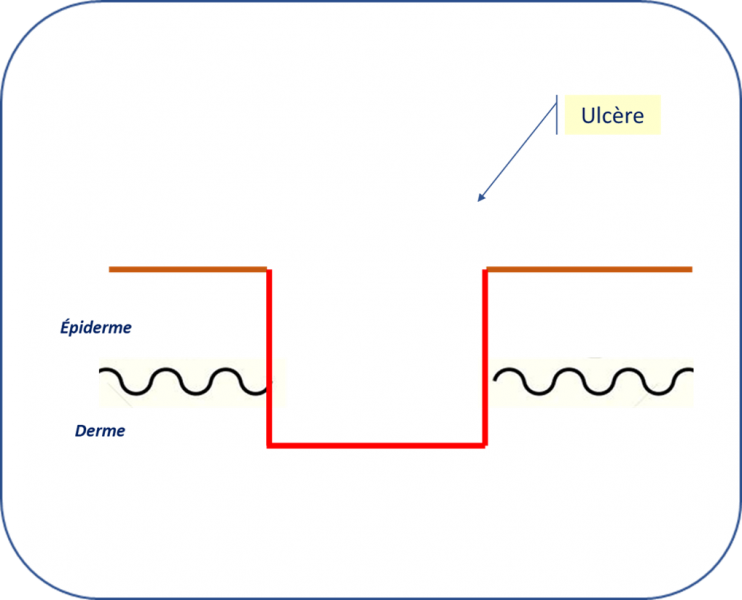 Fichier:Ulcère.png