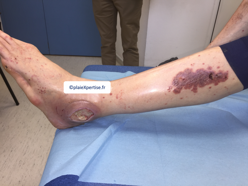 Fichier:Vascularite11.png