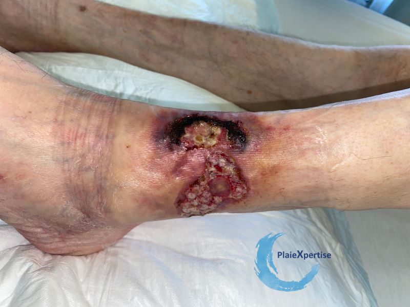 Fichier:Angiodermite typique85.jpg