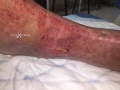 Dermite d'irritation13.jpg