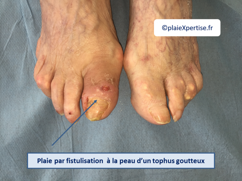 Fichier:Goutte et Tophus6.png
