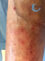 Pustules12.jpg
