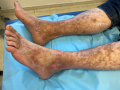 Dermiteocre40.png