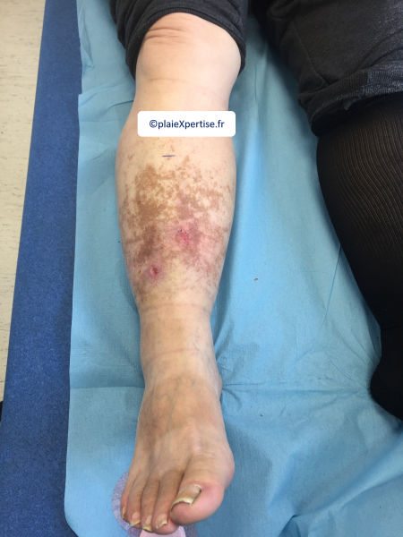 Fichier:Dermiteocre8.png