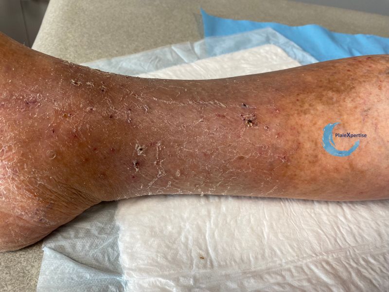 Fichier:Eczéma craquelé39.jpg