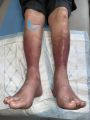 Hypodermite chronique56.jpg