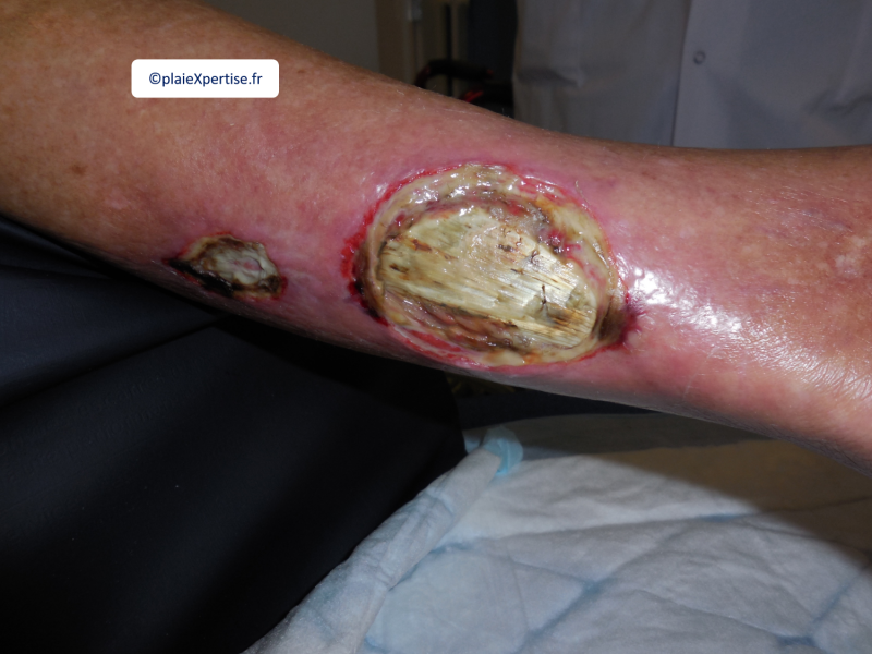 Fichier:Tendon nécrotique humide15.png