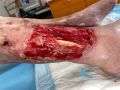 Tendon normal47.jpg