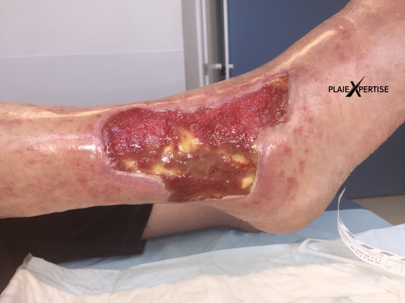 Fichier:Tissu de granulation inflammatoire21.png