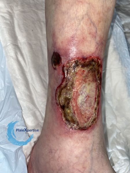 Fichier:Angiodermite typique92.jpg