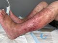 Eczéma138.jpg