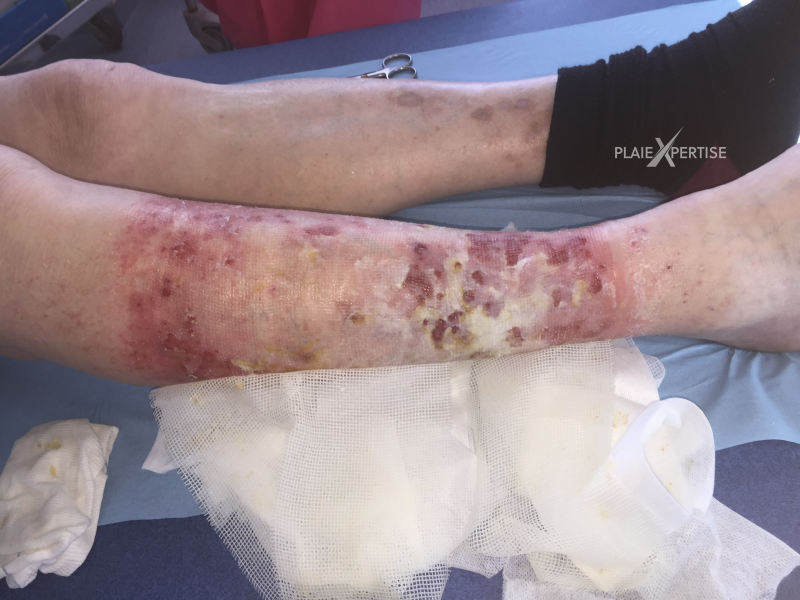 Fichier:Plaie cribiforme12.png