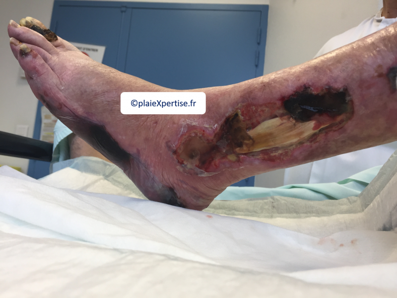 Fichier:Tendon nécrotique humide17.png