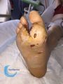 Amputation41.jpg