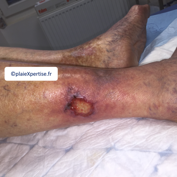 Fichier:Angiodermite typique13.png