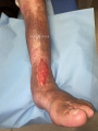 Tendon-Reliquat12.png