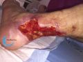 Tendon-Reliquat23.jpg