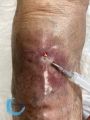 Fistule17.jpg