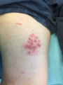 Herpes et zona1.png