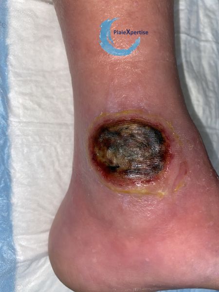 Fichier:Pyoderma gangrenosum26.jpg