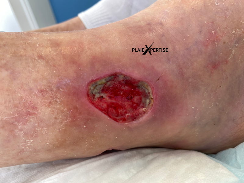 Fichier:Tissu de granulation normal18.png
