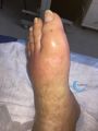 Pied goutteux5.jpg