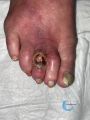 Pied infecté34.jpg